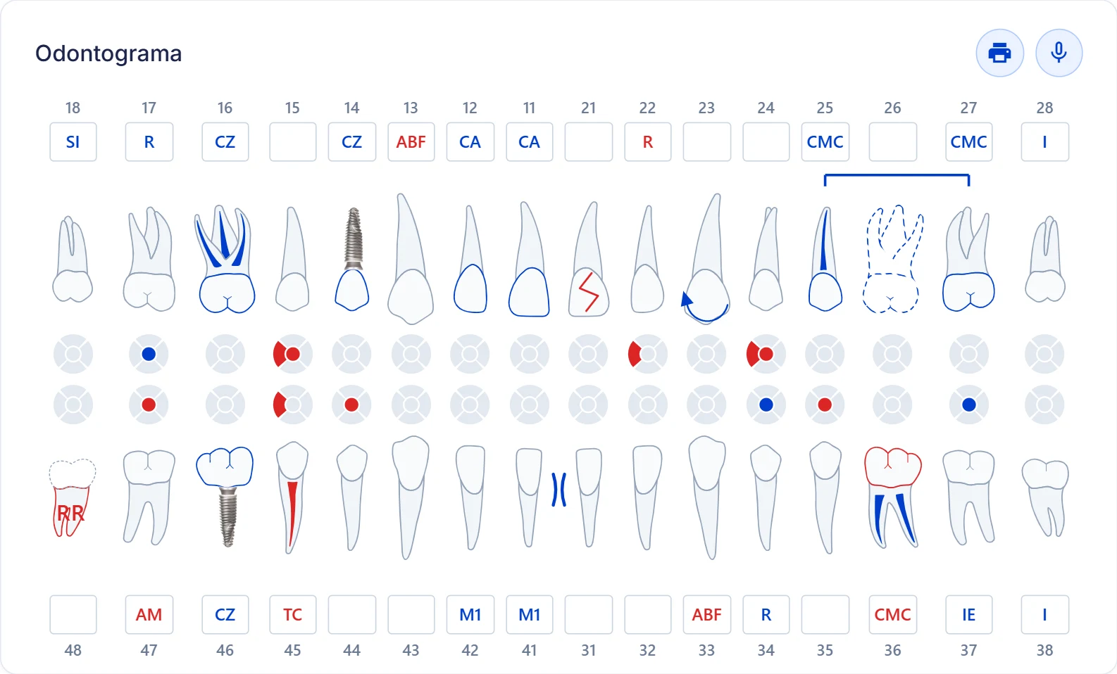 Odontograma con implantes, endodoncias, coronas, un puente y caries